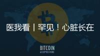 医我看丨罕见！心脏长在右胸膛！珠海成功开展首例“右位心”房颤射频消融术